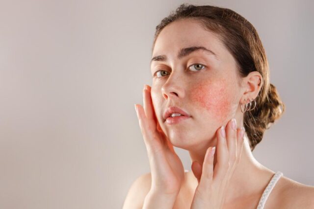 How To Ease And Prevent Eczema Flare Ups The Messenger